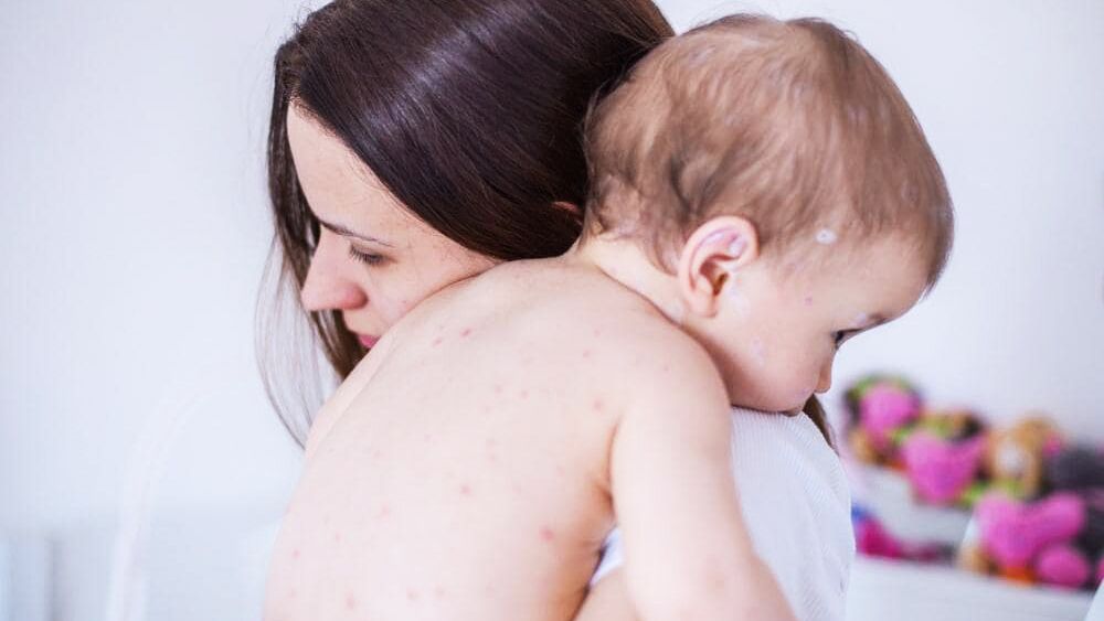 Homeopathy for skin ailments